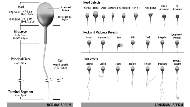 Normal and Abnormal Sperm Cells